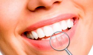 implantes dentales madrid 